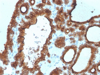 IHC staining of FFPE human thyroid carcinoma with Thyroid Peroxidase antibody. HIER: boil tissue sections in pH 9 10mM Tris with 1mM EDTA for 20 min and allow to cool before testing.