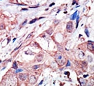 IHC analysis of FFPE human breast carcinoma tissue stained with the JNK3 antibody