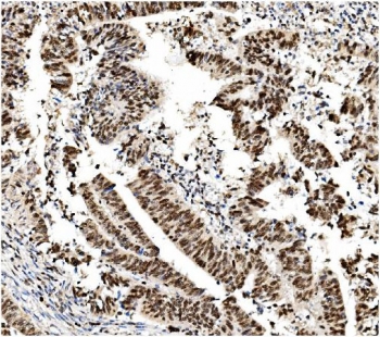 IHC staining of FFPE human rectal cancer with MCM2 antibody. HIER: boil tissue sections in pH8 EDTA for 20 min and allow to cool before testing.