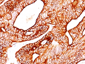 IHC: Formalin-fixed, paraffin-embedded human colon carcinoma stained with Cytokeratin 8/18 antibody (KRT8/803 + KRT18/835).