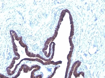 IHC: Formalin-fixed, paraffin-embedded human ovarian carcinoma stained with Cytokeratin 8/18 antibody (KRT8/803 + KRT18/835).