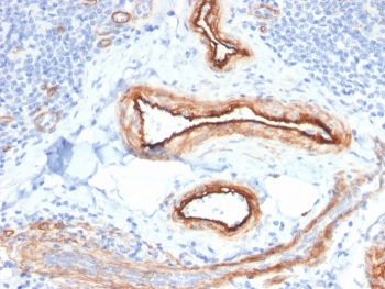 IHC staining of FFPE human renal cell carcinoma with MTF1 antibody. HIER: boil tissue sections in pH 9 10mM Tris with 1mM EDTA for 20 min and allow to cool before testing.