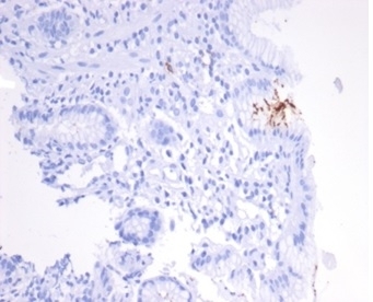 IHC staining of FFPE human H. pylori-infected stomach tissue with H pylori Catalase antibody (clone HPYL/7170). HIER: boil tissue sections in pH 9 10mM Tris with 1mM EDTA for 20 min and allow to cool before testing.