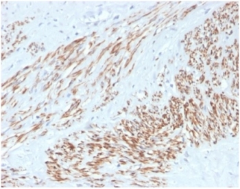 IHC staining of FFPE human leiomyosarcoma tissue with recombinant MYH11 antibody (clone MYH11/4337R). HIER: boil tissue sections in pH 9 10mM Tris with 1mM EDTA for 20 min and allow to cool before testing.