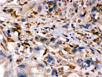 IHC testing of FFPE human intestinal cancer tissue with TAP1 antibody. HIER: Boil the paraffin sections in pH 6, 10mM citrate buffer for 20 minutes and allow to cool prior to staining.