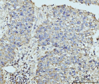 IHC staining of FFPE human liver cancer tissue with hUPF2 antibody. HIER: boil tissue sections in pH8 EDTA for 20 min and allow to cool before testing.