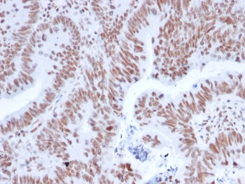IHC staining of FFPE human colon carcinoma with NRF1 antibody. HIER: boil tissue sections in pH 9 10mM Tris with 1mM EDTA for 20 min and allow to cool before testing.