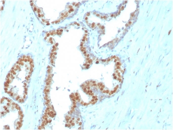 IHC staining of FFPE human prostate carcinoma with NKX3.1 antibody. HIER: boil tissue sections in pH 9 10mM Tris with 1mM EDTA for 20 min and allow to cool before testing.
