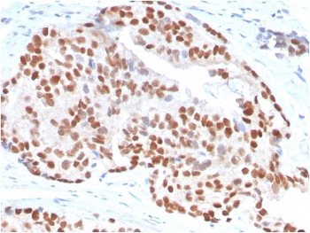 IHC staining of FFPE human prostate carcinoma with NKX3.1 antibody. HIER: boil tissue sections in pH 9 10mM Tris with 1mM EDTA for 20 min and allow to cool before testing.