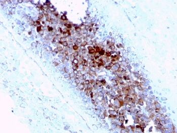 IHC staining of FFPE human melanoma with CD63 antibody (clone LAMP3/2789). HIER: boil tissue sections in pH 9 10mM Tris with 1mM EDTA for 20 min and allow to cool before testing.