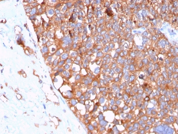 IHC staining of FFPE human urothelial carcinoma with UPK1B antibody. HIER: boil tissue sections in pH 9 10mM Tris with 1mM EDTA for 20 min and allow to cool before testing.