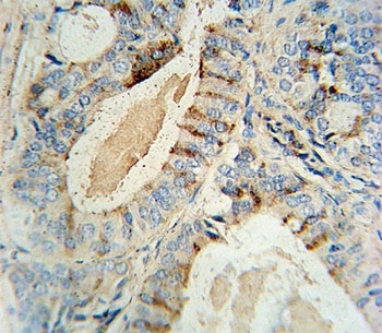 GCNT2 antibody immunohistochemistry analysis in formalin fixed and paraffin embedded human prostate carcinoma.