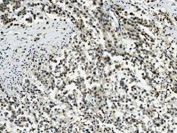 IHC staining of FFPE human pancreatic cancer with Transketolase antibody. HIER: boil tissue sections in pH8 EDTA for 20 min and allow to cool before testing.