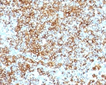 IHC: Formalin-fixed, paraffin-embedded human lymphoma stained with anti-CD45RB antibody (SPM569).