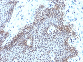 IHC staining of FFPE human cervical carcinoma with recombinant SOX11 antibody (clone SOX11/3235R). HIER: boil tissue sections in pH 9 10mM Tris with 1mM EDTA for 20 min and allow to cool before testing.