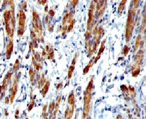 IHC testing of FFPE human Leiomyosarcoma with SMMHC antibody (clone SMM11-1). FFPE testing requires sections to be boiled in pH 9 10mM Tris with 1mM EDTA for 10-20 minutes, followed by cooling at RT for 20 minutes, prior to staining.