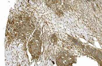 IHC staining of FFPE human ovarian serous adenocarcinoma with TUBA1 antibody. HIER: boil tissue sections in pH8 EDTA for 20 min and allow to cool before testing.