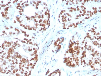 IHC staining of FFPE human prostate carcinoma with NKX3.1 antibody. HIER: boil tissue sections in pH 9 10mM Tris with 1mM EDTA for 20 min and allow to cool before testing.