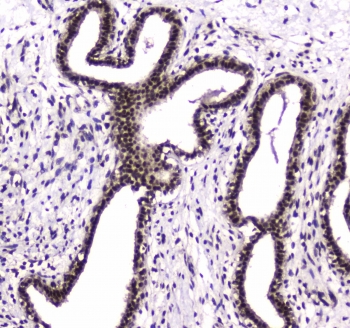 IHC testing of FFPE human breast cancer tissue with PARN antibody at 1ug/ml. Required HIER: steam section in pH6 citrate buffer for 20 min and allow to cool prior to staining.