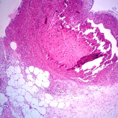 Human Chronic Peptic Ulcer, sec. 7 µm H&E Microscope Slide