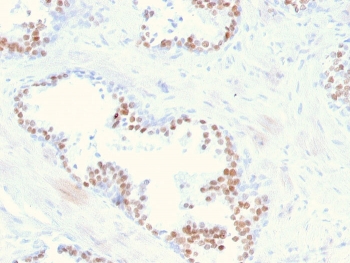 IHC staining of FFPE human prostate with NKX3.1 antibody. HIER: boil tissue sections in pH 9 10mM Tris with 1mM EDTA for 20 min and allow to cool before testing.