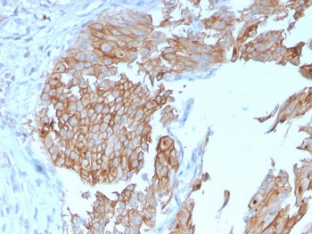 IHC staining of FFPE human urothelial carcinoma with UPK1B antibody. HIER: boil tissue sections in pH 9 10mM Tris with 1mM EDTA for 20 min and allow to cool before testing.