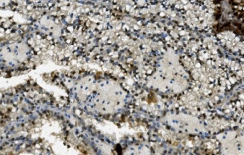 IHC staining of FFPE human renal carcinoma with TKT antibody. HIER: boil tissue sections in pH8 EDTA for 20 min and allow to cool before testing.