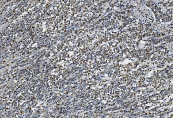 IHC staining of FFPE human gastric cancer with TKT antibody. HIER: boil tissue sections in pH8 EDTA for 20 min and allow to cool before testing.