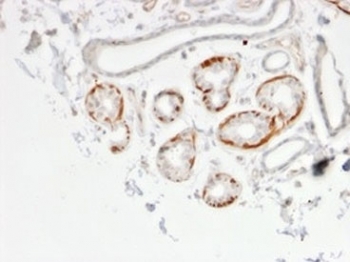 IHC staining of FFPE human breast carcinoma tissue with GTF2H2C antibody (clone PCRP-GTF2H2C-2C9). HIER: boil tissue sections in pH 9 10mM Tris with 1mM EDTA for 20 min and allow to cool before testing.