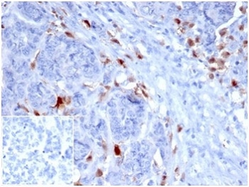 IHC staining of FFPE human ovarian carcinoma with SREBP1 antibody (clone SREBP1/1578). HIER: boil tissue sections in pH 9 10mM Tris with 1mM EDTA for 20 min and allow to cool before testing. Negative control inset: PBS used instead of primary antibody to control for secondary Ab binding.
