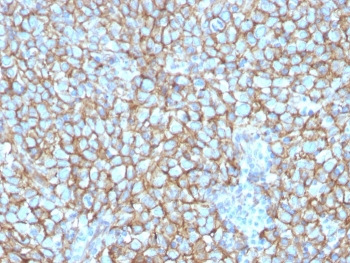 IHC staining of FFPE human melanoma with MCAM antibody. HIER: boil tissue sections in pH 9 10mM Tris with 1mM EDTA for 20 min and allow to cool before testing.