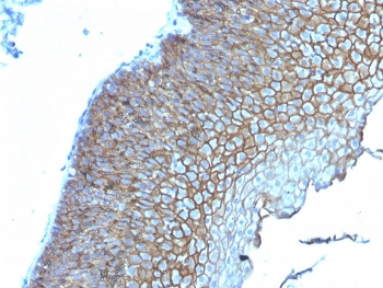 IHC staining of FFPE human esophageal carcinoma with Desmoglein 3 antibody (clone DSG3/2839). HIER: boil tissue sections in pH 9 10mM Tris with 1mM EDTA for 10-20 min and allow to cool before testing.