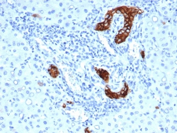IHC staining of FFPE human colorectal liver metastasis with recombinant TACSTD2 antibody (clone rTACSTD2/6397). HIER: boil tissue sections in pH 9 10mM Tris with 1mM EDTA for 20 min and allow to cool before testing.